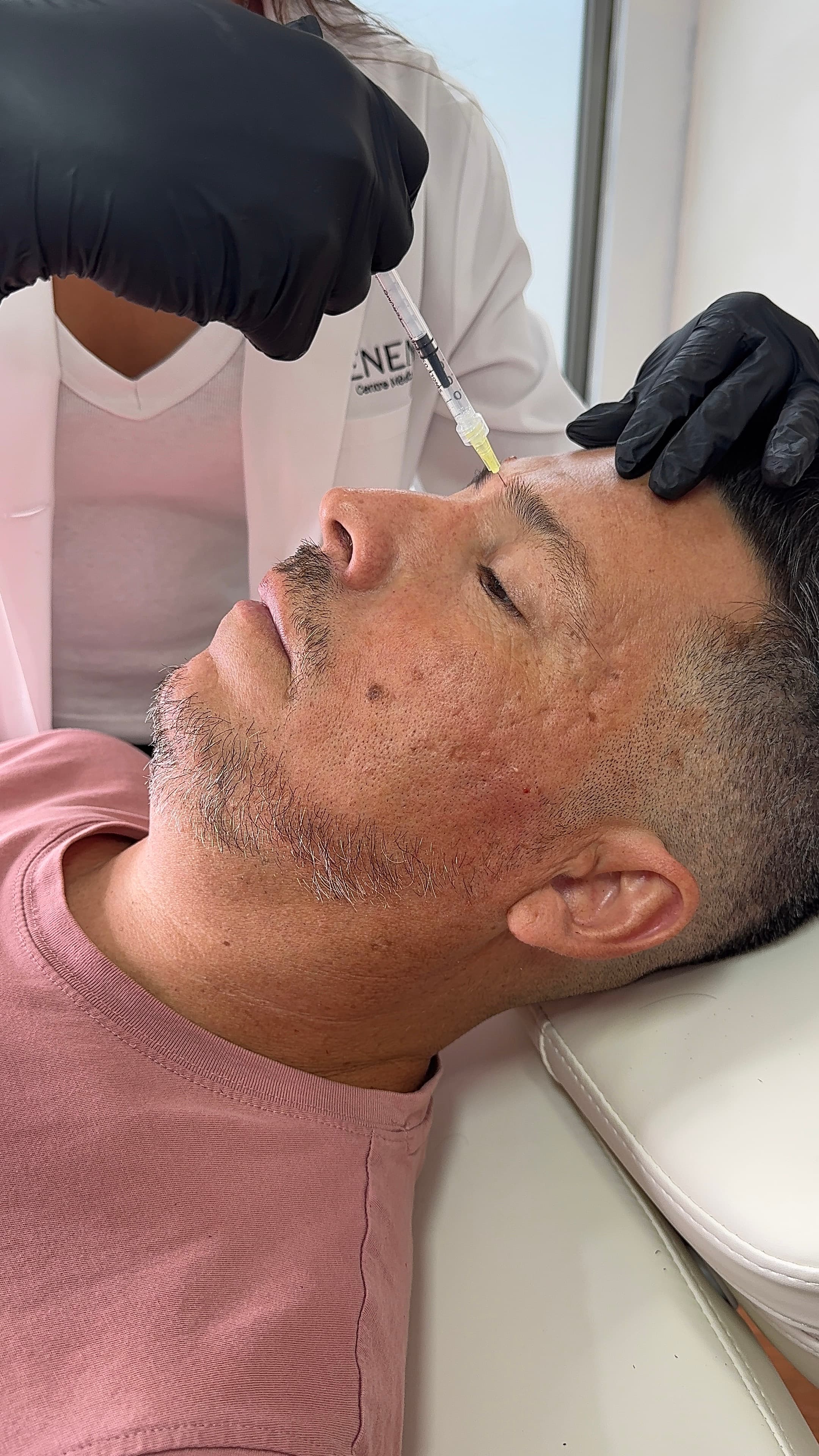 Tratamiento de arrugas de expresión.
