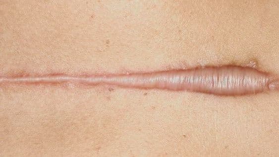Cicatrices Queloides y Cicatrices Hipertróficas