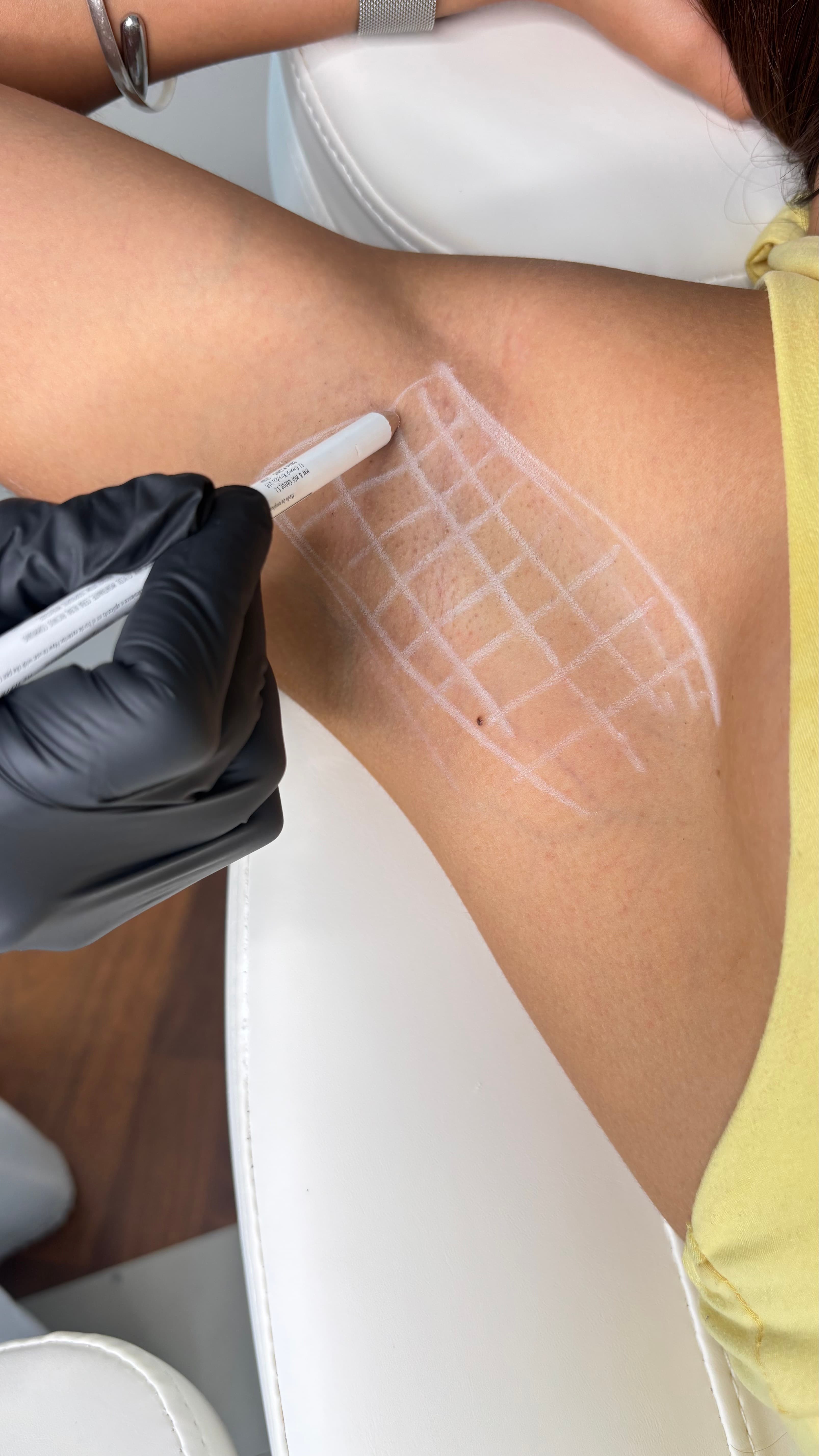 Tratamiento de la Hiperhidrosis