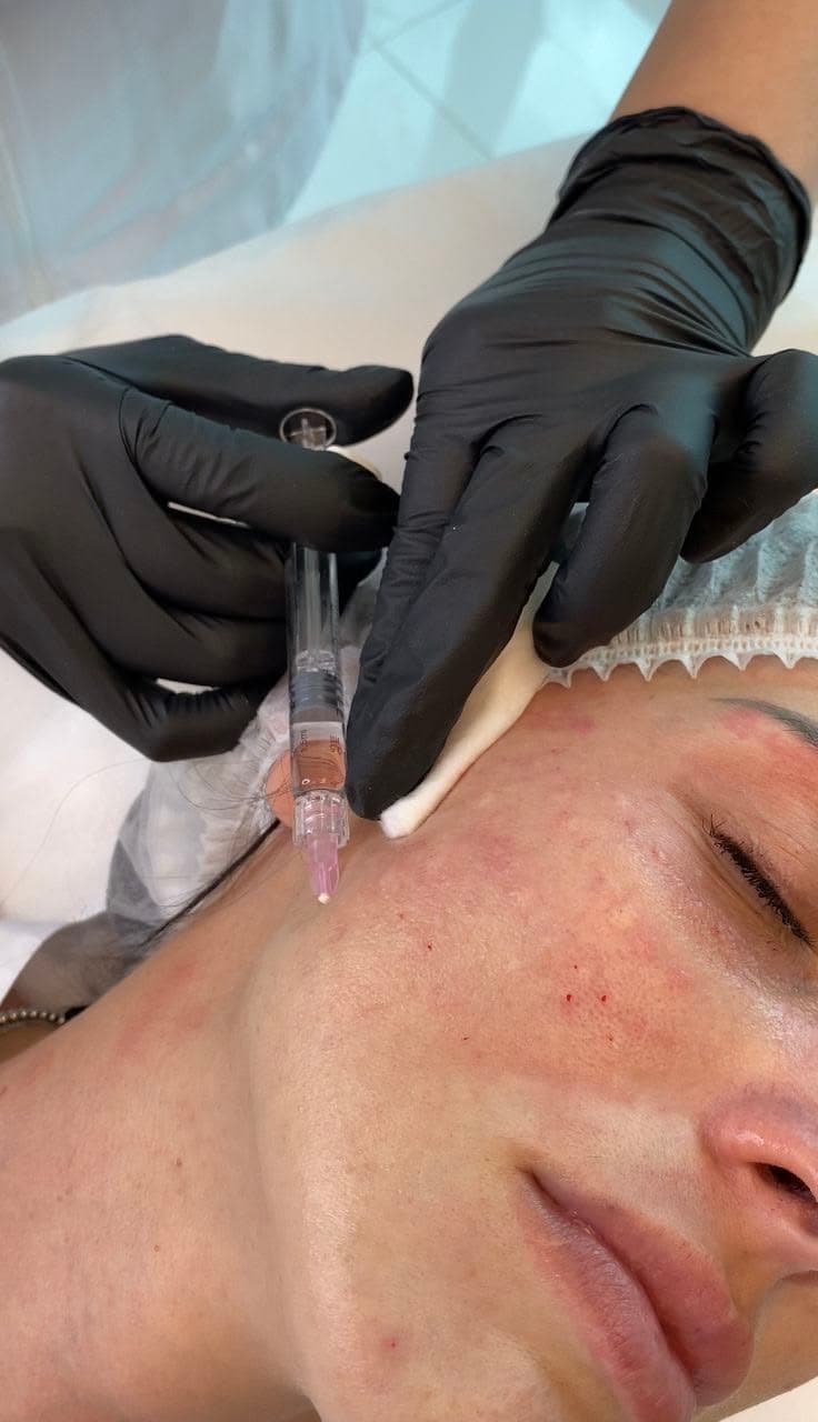 Bioestimulación con Polinucleótidos.