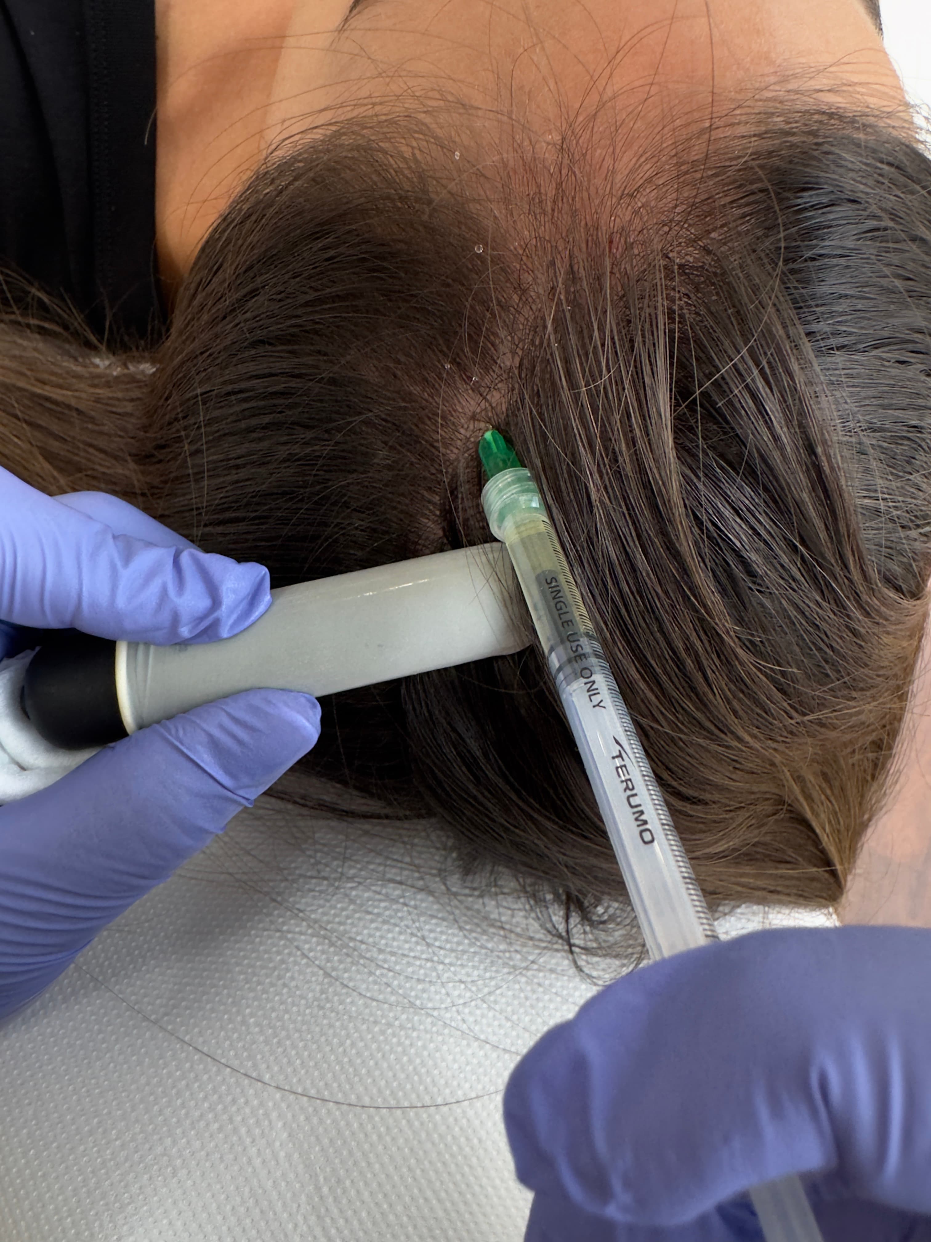 Plasma Rico en Plaquetas (PRP) Capilar