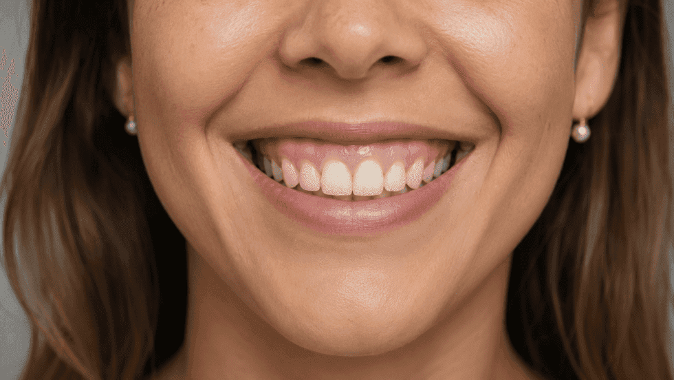 Corrección de la Sonrisa Gingival